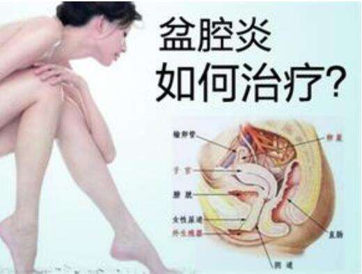 盆腔炎怎么治疗？